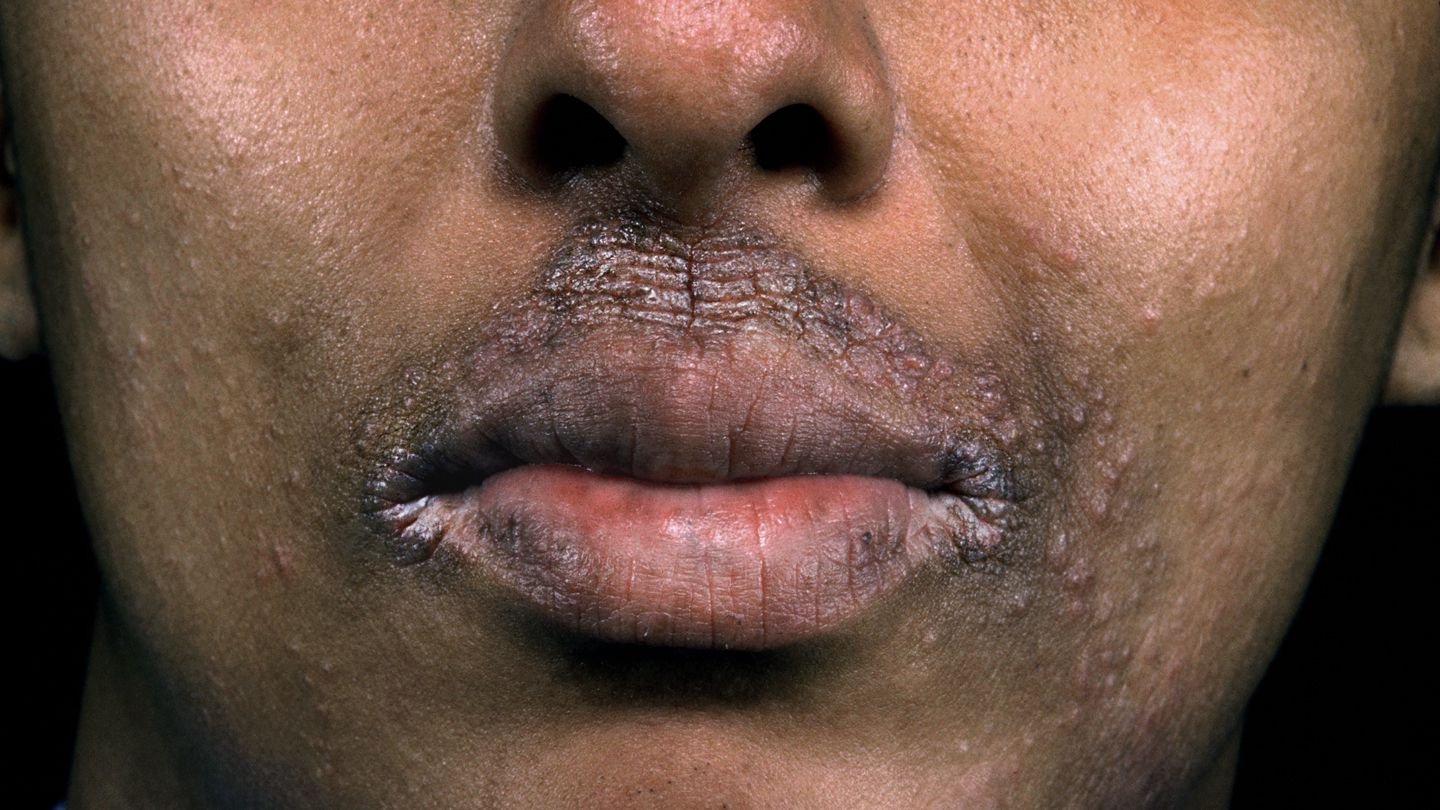 PRP Hair Restoration